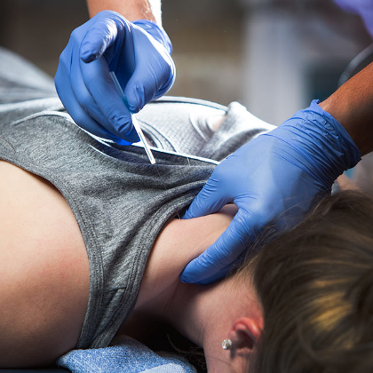 dry_needling_2